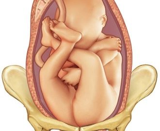 Breech presentation baby shown at the top of a woman's pelvic area
