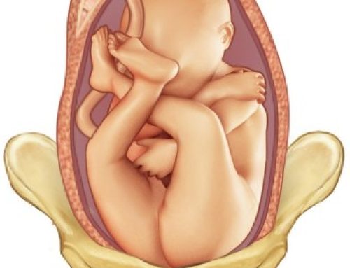 Breech Presentation at the End of Pregnancy