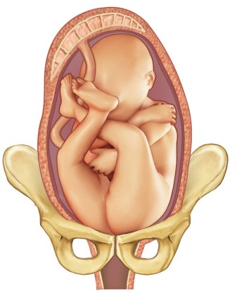 Breech presentation baby shown at the top of a woman's pelvic area
